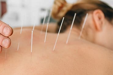 Acupuncture Services in Churchgate