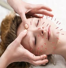 Acupuncture Services