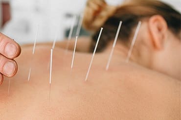 Acupuncture Services in Jogeshwari